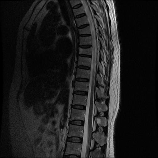 C#处理医学影像(四):基于Stitcher算法拼接人体全景脊柱骨骼影像