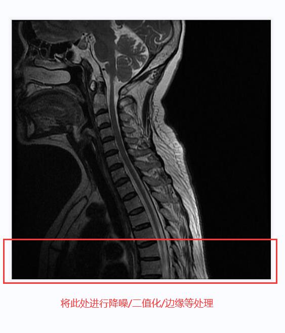 C#处理医学影像(四):基于Stitcher算法拼接人体全景脊柱骨骼影像